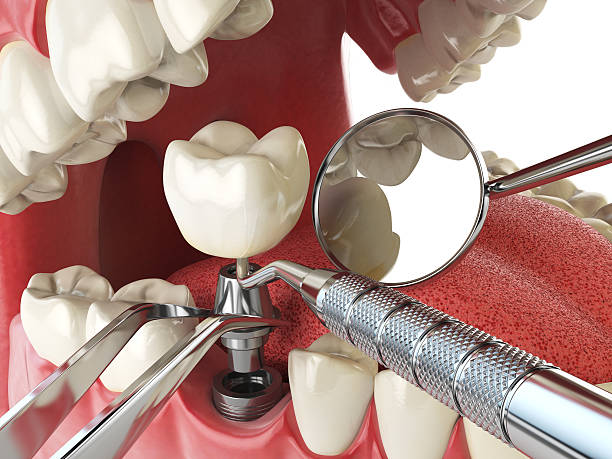 Best Emergency Dental Care for Broken or Chipped Teeth in , DE
